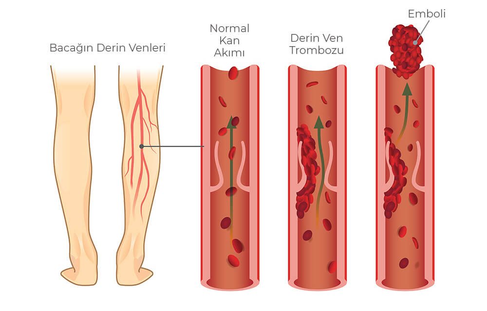 ATABAY-Derin-ven-trombozu